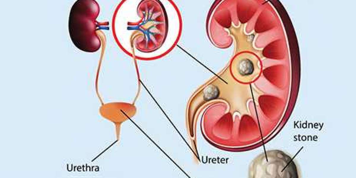 Which specialist is best for a kidney stone?