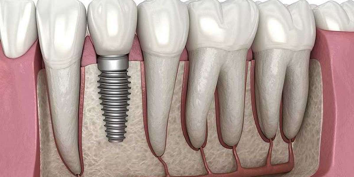 Transform Your Smile with Dental Implants and Bridges at San Dimas Dental Care in Bakersfield